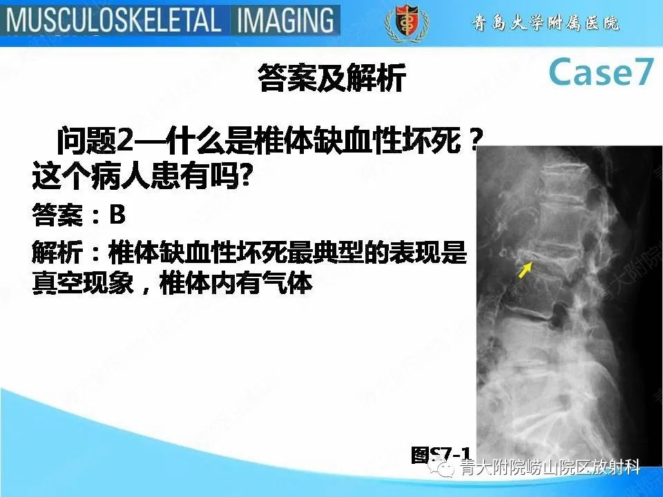 影像PPT - 【PPT】椎体缺血性坏死-7
