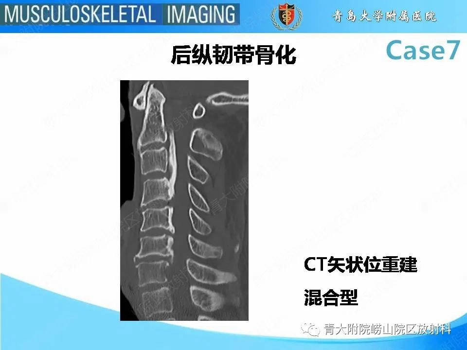 影像PPT - 【PPT】椎体缺血性坏死-11