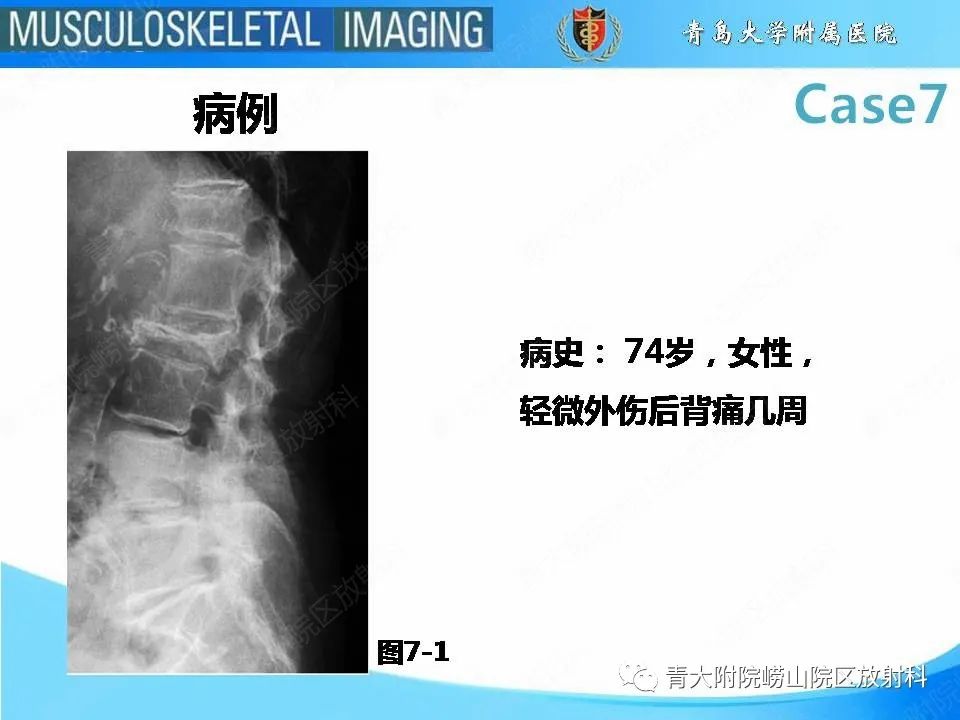 影像PPT - 【PPT】椎体缺血性坏死-2