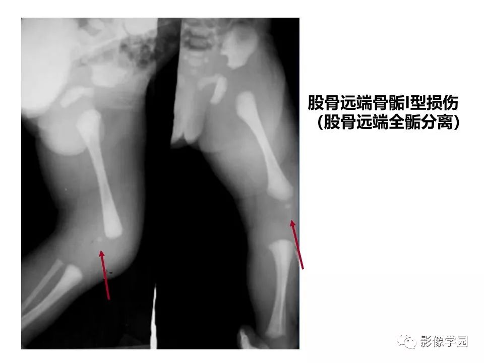 影像PPT - 【PPT】儿童骨骺损伤影像诊断-9