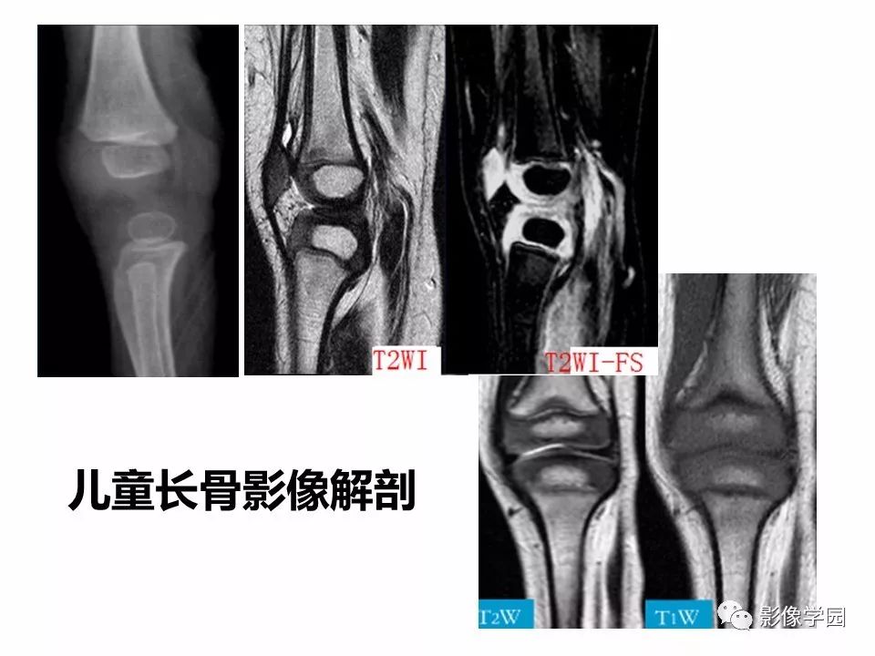 影像PPT - 【PPT】儿童骨骺损伤影像诊断-5