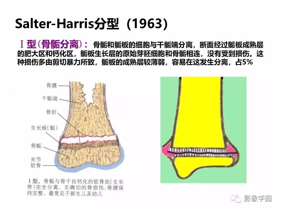 影像PPT - 【PPT】儿童骨骺损伤影像诊断-8
