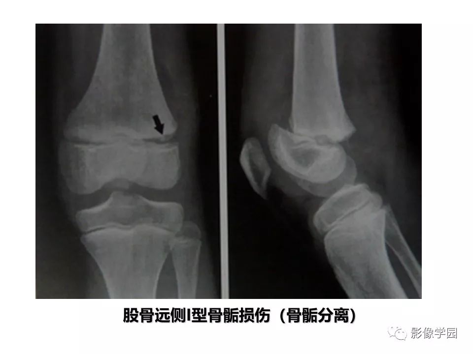 影像PPT - 【PPT】儿童骨骺损伤影像诊断-10