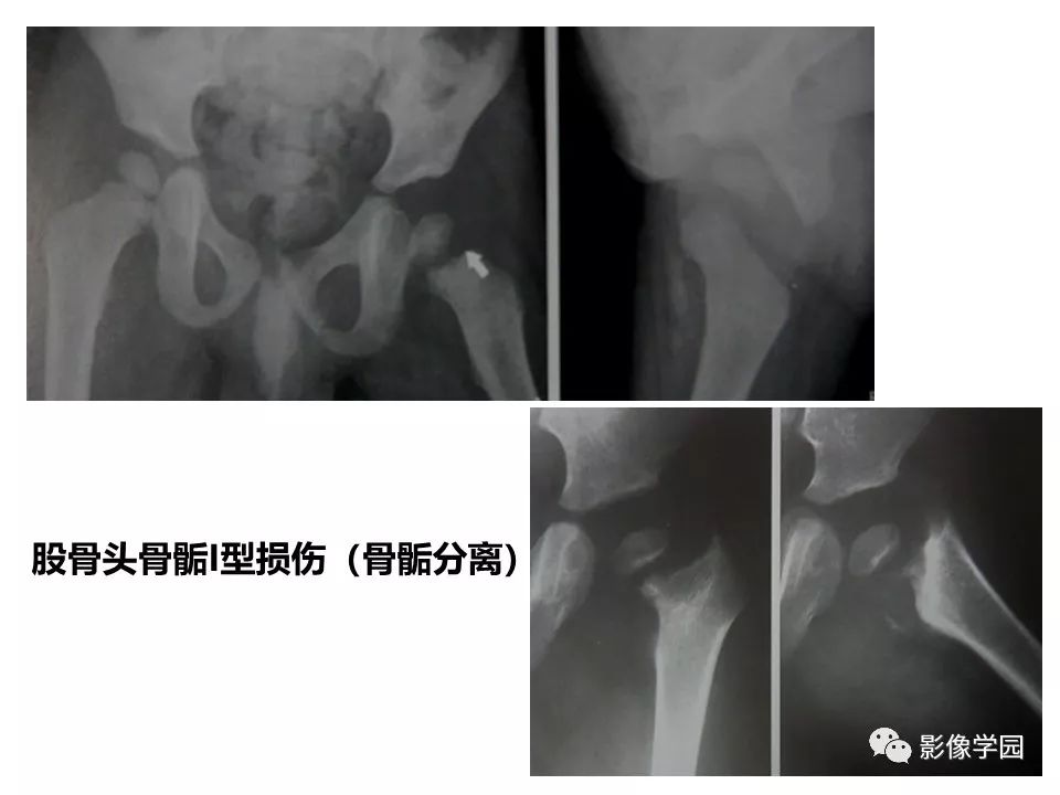 影像PPT - 【PPT】儿童骨骺损伤影像诊断-11