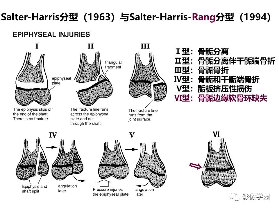 影像PPT - 【PPT】儿童骨骺损伤影像诊断-7