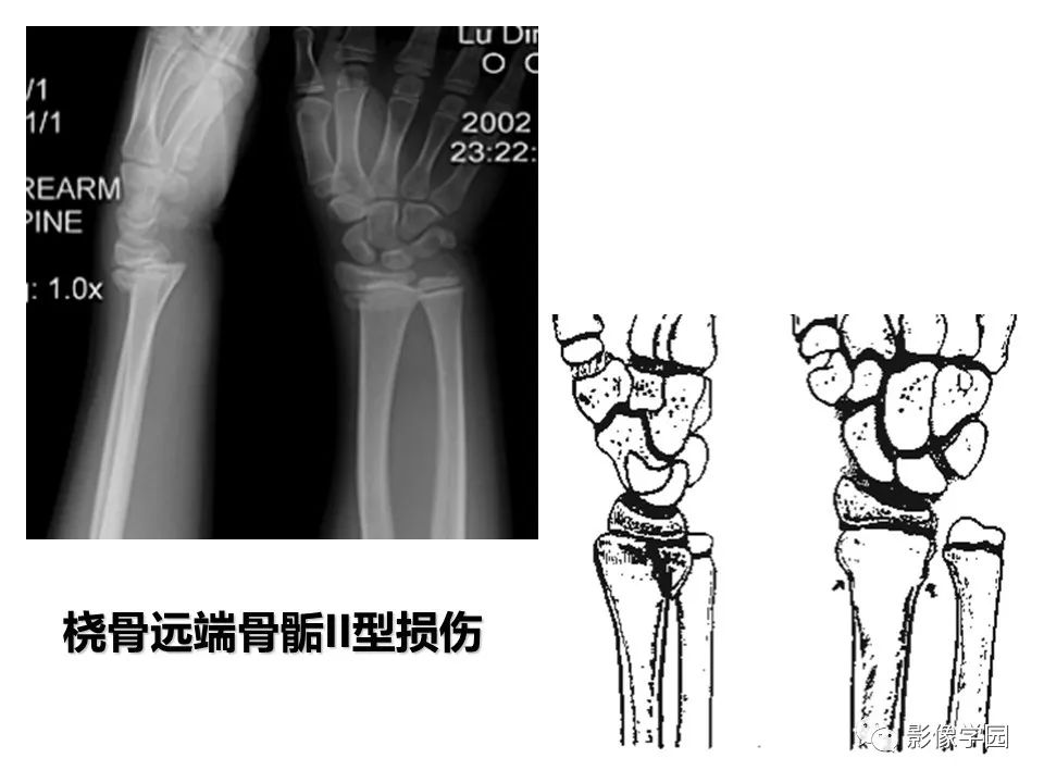 影像PPT - 【PPT】儿童骨骺损伤影像诊断-14
