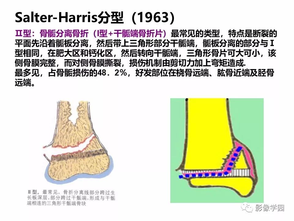 影像PPT - 【PPT】儿童骨骺损伤影像诊断-13