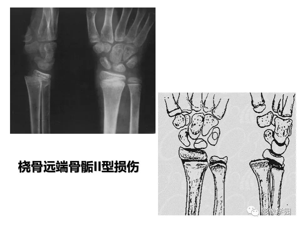 影像PPT - 【PPT】儿童骨骺损伤影像诊断-15