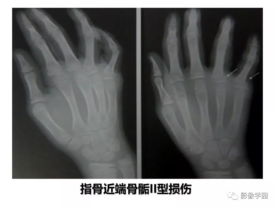影像PPT - 【PPT】儿童骨骺损伤影像诊断-16