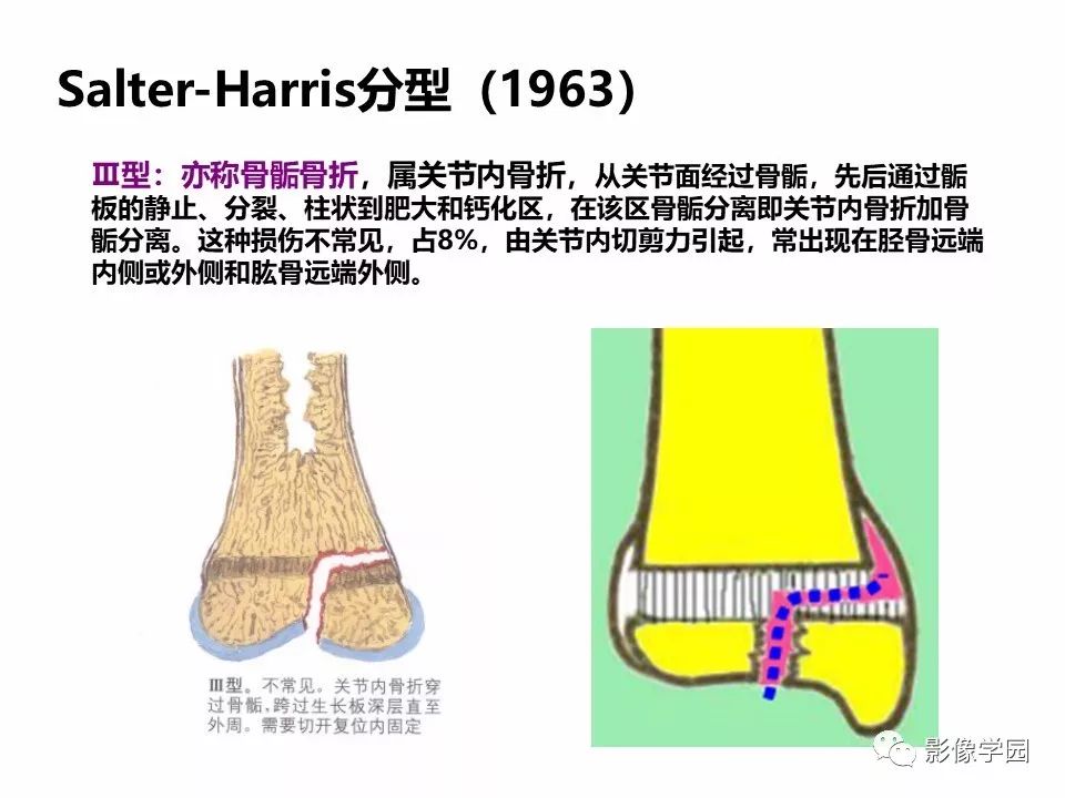 影像PPT - 【PPT】儿童骨骺损伤影像诊断-18