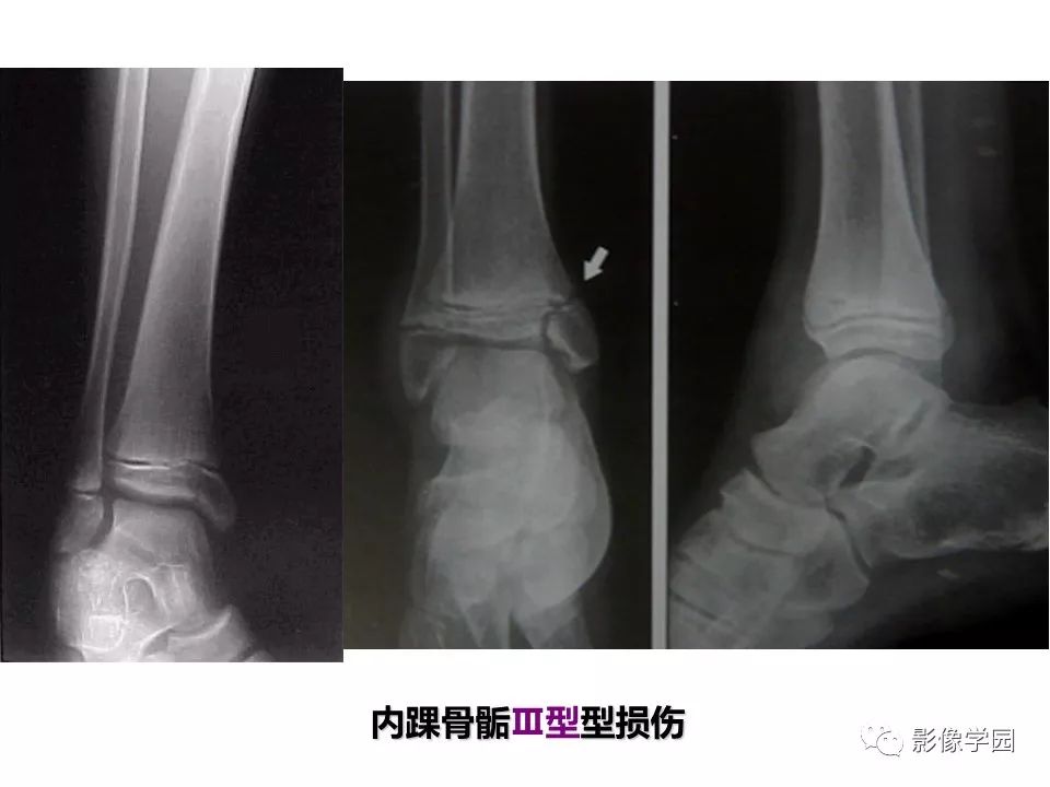 影像PPT - 【PPT】儿童骨骺损伤影像诊断-19