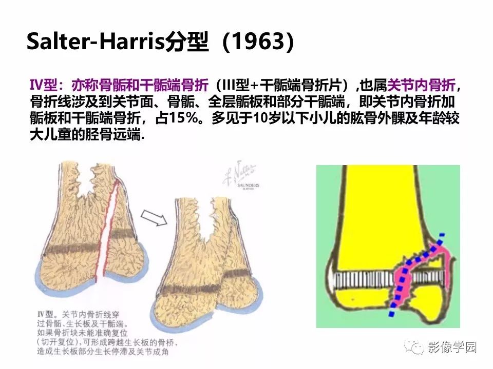 影像PPT - 【PPT】儿童骨骺损伤影像诊断-21