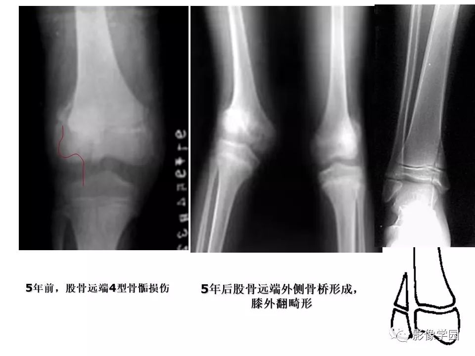 影像PPT - 【PPT】儿童骨骺损伤影像诊断-22