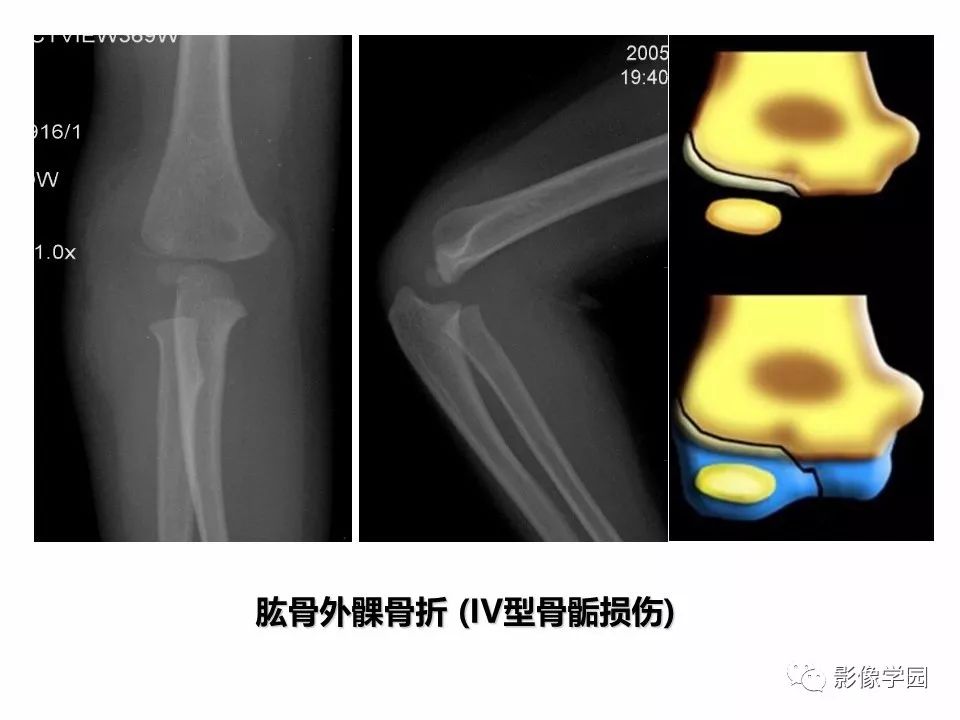 影像PPT - 【PPT】儿童骨骺损伤影像诊断-23