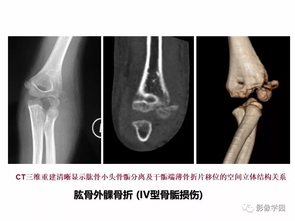影像PPT - 【PPT】儿童骨骺损伤影像诊断-24