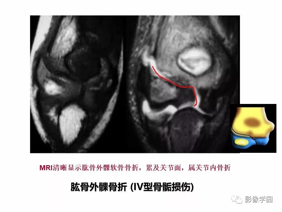 影像PPT - 【PPT】儿童骨骺损伤影像诊断-25