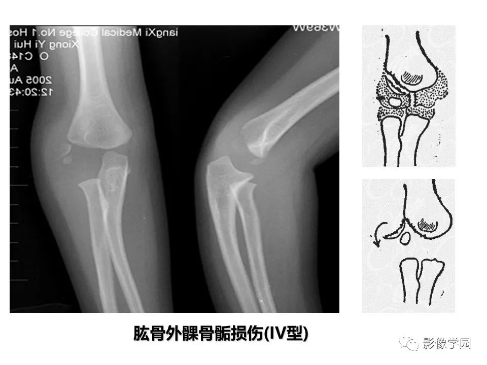 影像PPT - 【PPT】儿童骨骺损伤影像诊断-26