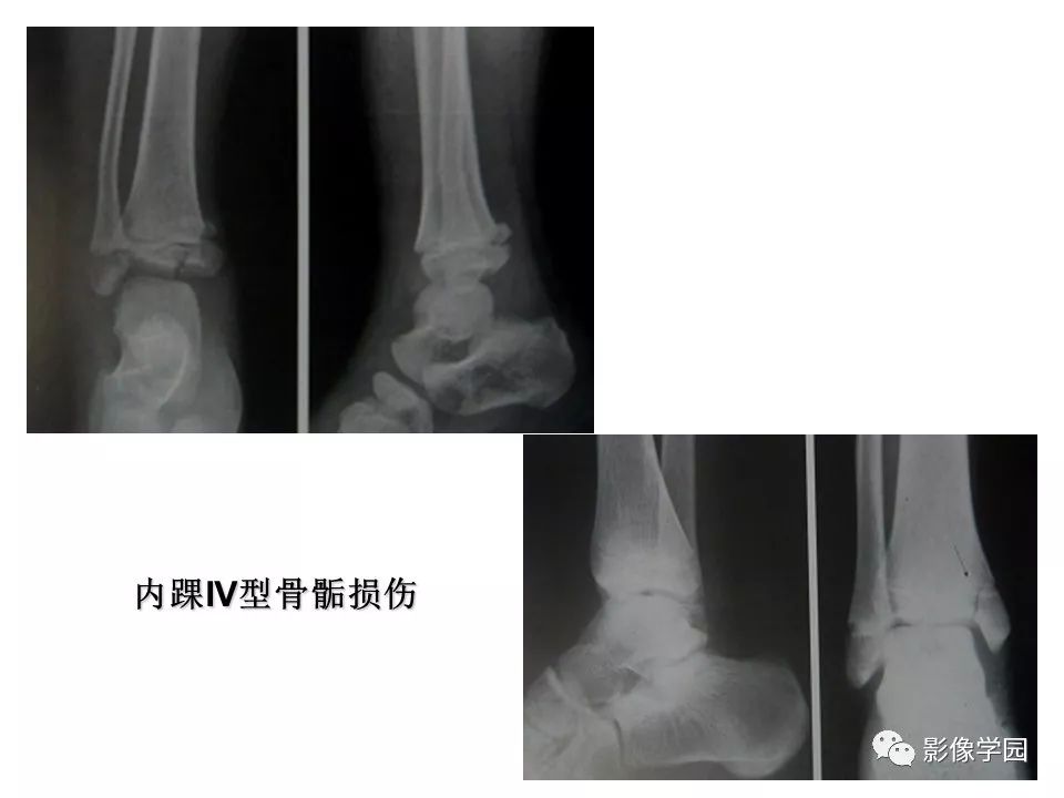 影像PPT - 【PPT】儿童骨骺损伤影像诊断-27
