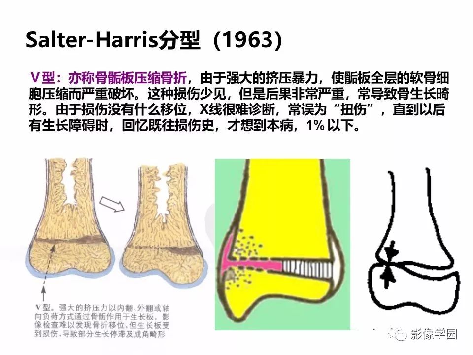 影像PPT - 【PPT】儿童骨骺损伤影像诊断-28