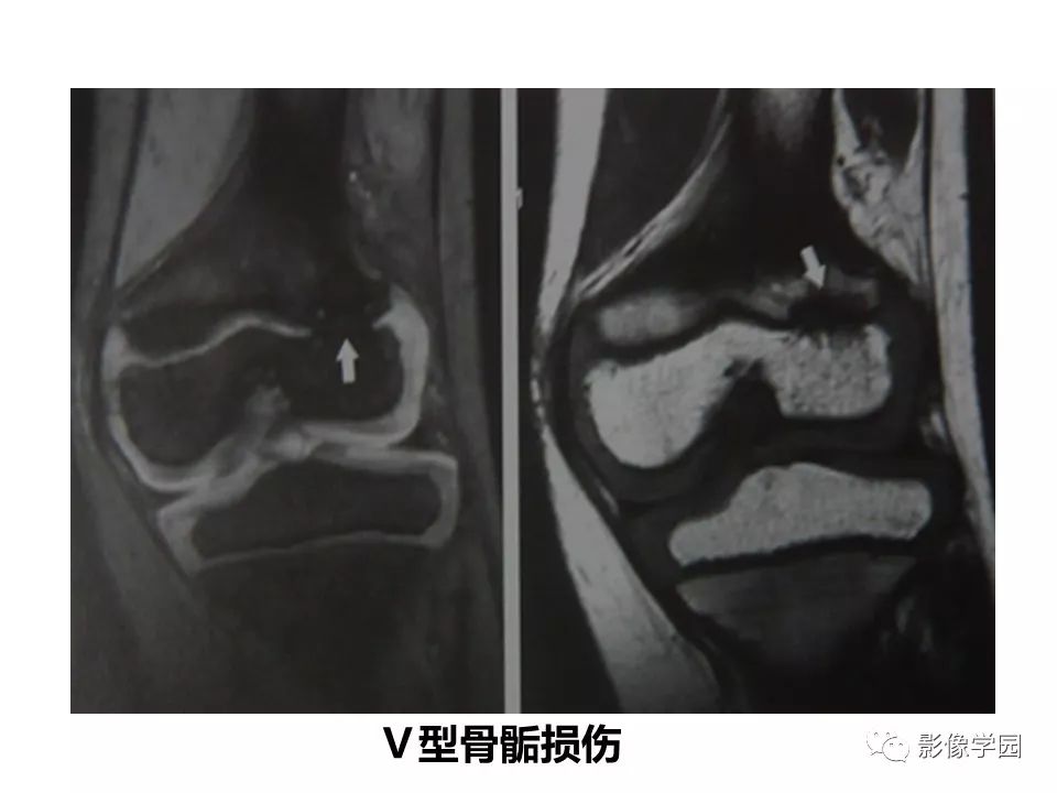 影像PPT - 【PPT】儿童骨骺损伤影像诊断-29