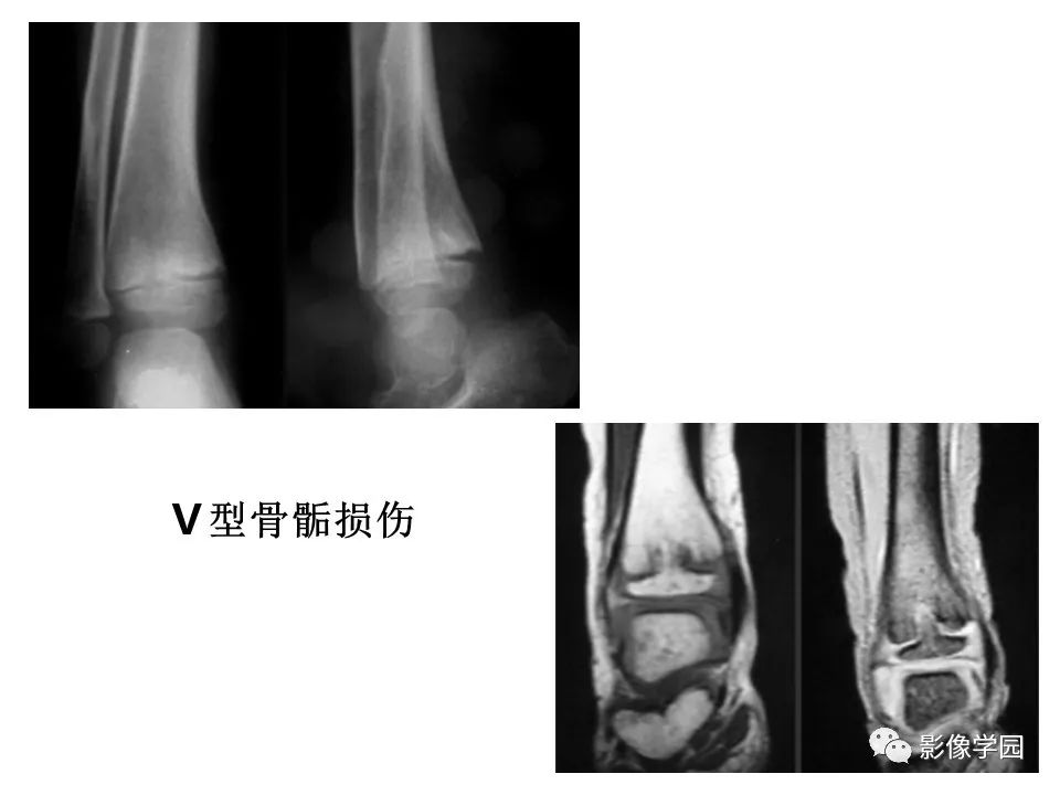 影像PPT - 【PPT】儿童骨骺损伤影像诊断-30