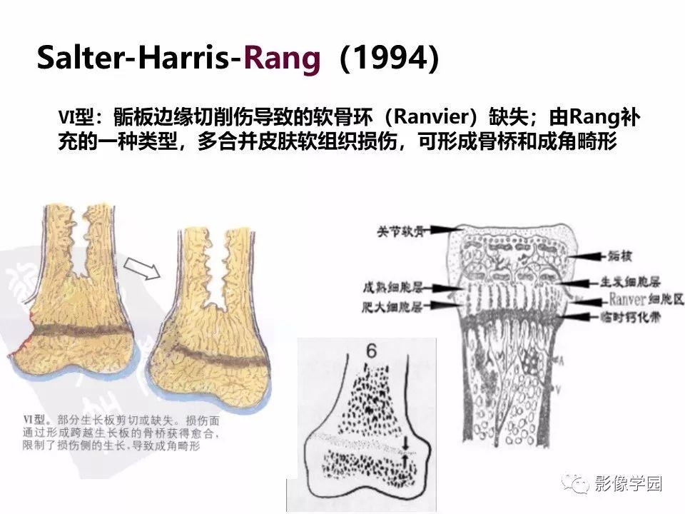 影像PPT - 【PPT】儿童骨骺损伤影像诊断-31