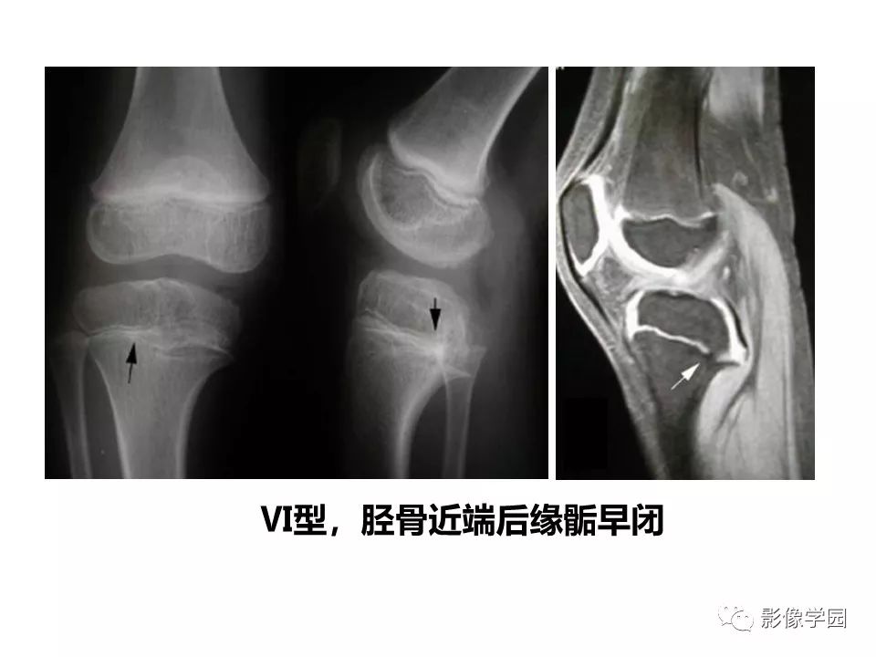 影像PPT - 【PPT】儿童骨骺损伤影像诊断-32