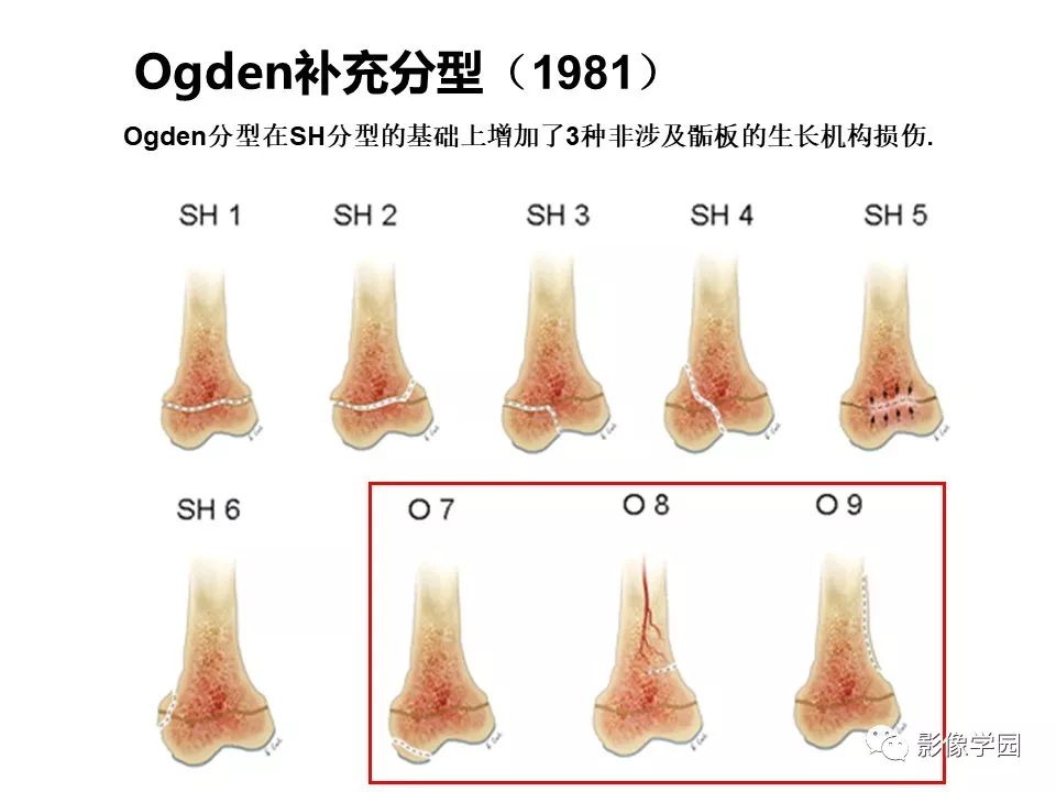影像PPT - 【PPT】儿童骨骺损伤影像诊断-33