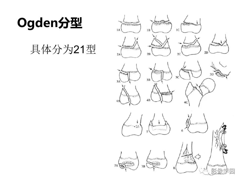 影像PPT - 【PPT】儿童骨骺损伤影像诊断-34