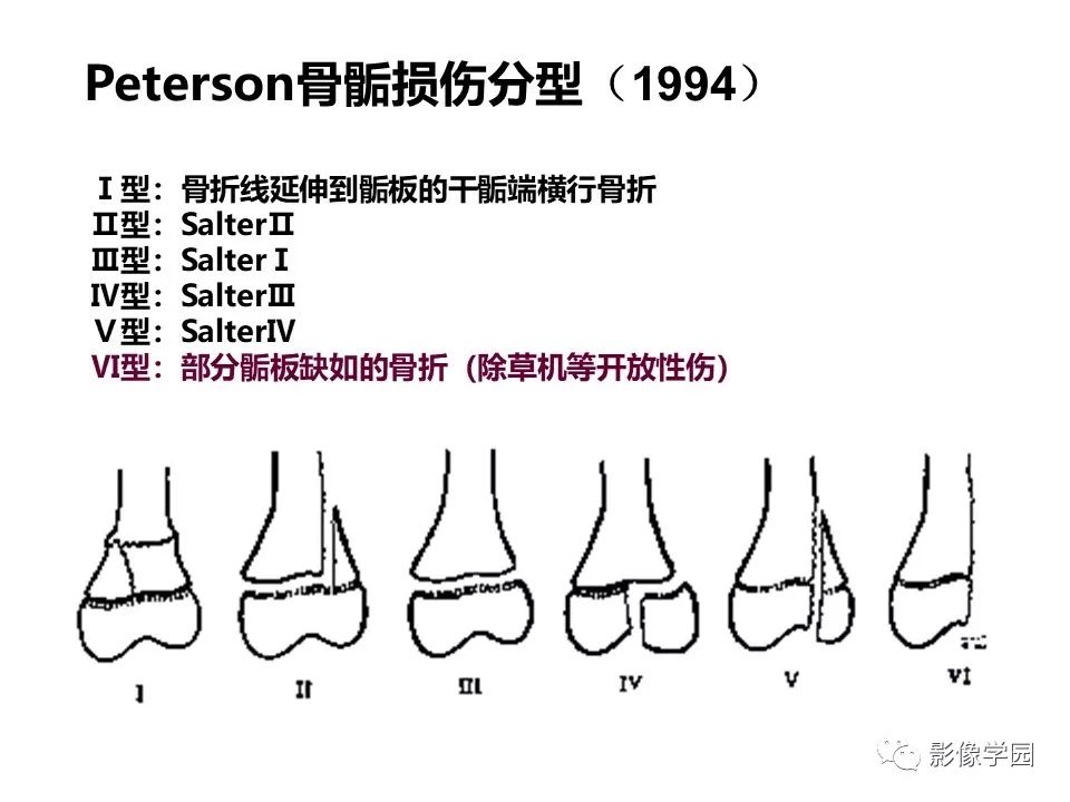影像PPT - 【PPT】儿童骨骺损伤影像诊断-35