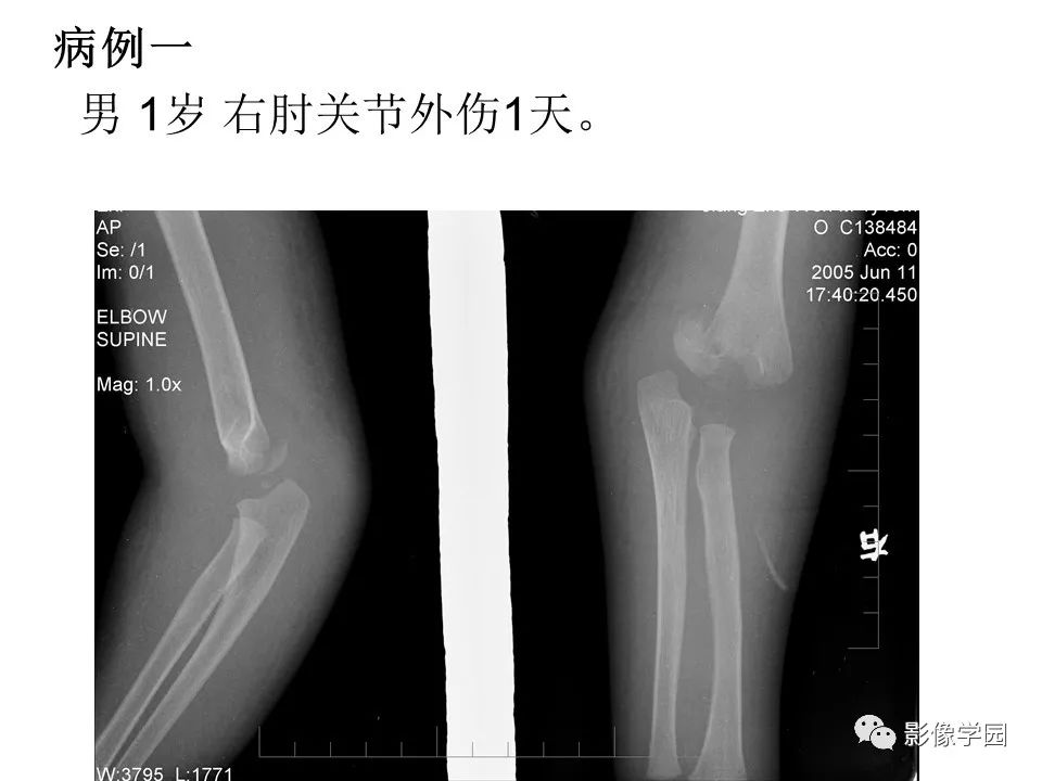 影像PPT - 【PPT】儿童骨骺损伤影像诊断-37