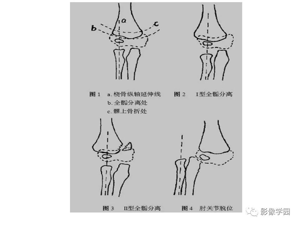 影像PPT - 【PPT】儿童骨骺损伤影像诊断-39
