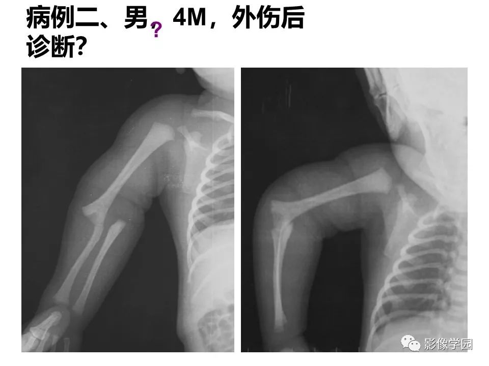 影像PPT - 【PPT】儿童骨骺损伤影像诊断-40