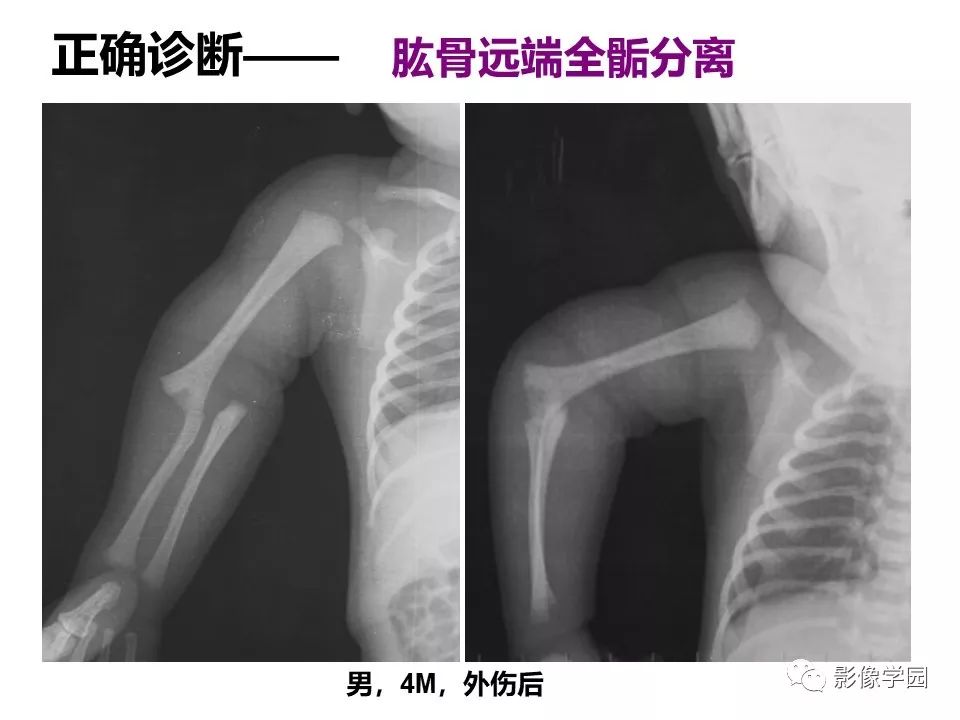影像PPT - 【PPT】儿童骨骺损伤影像诊断-41