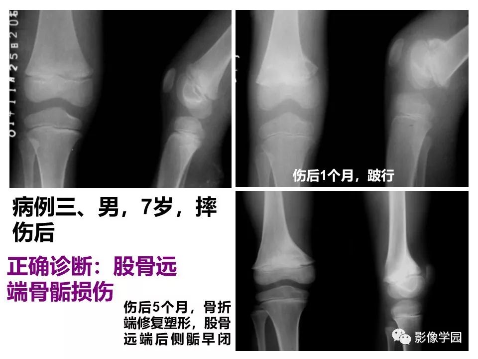 影像PPT - 【PPT】儿童骨骺损伤影像诊断-43