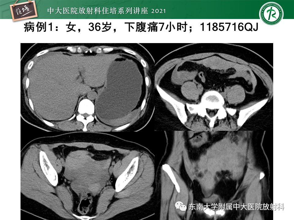 影像PPT - 【PPT】卵巢黄体及相关疾病诊断及鉴别-2