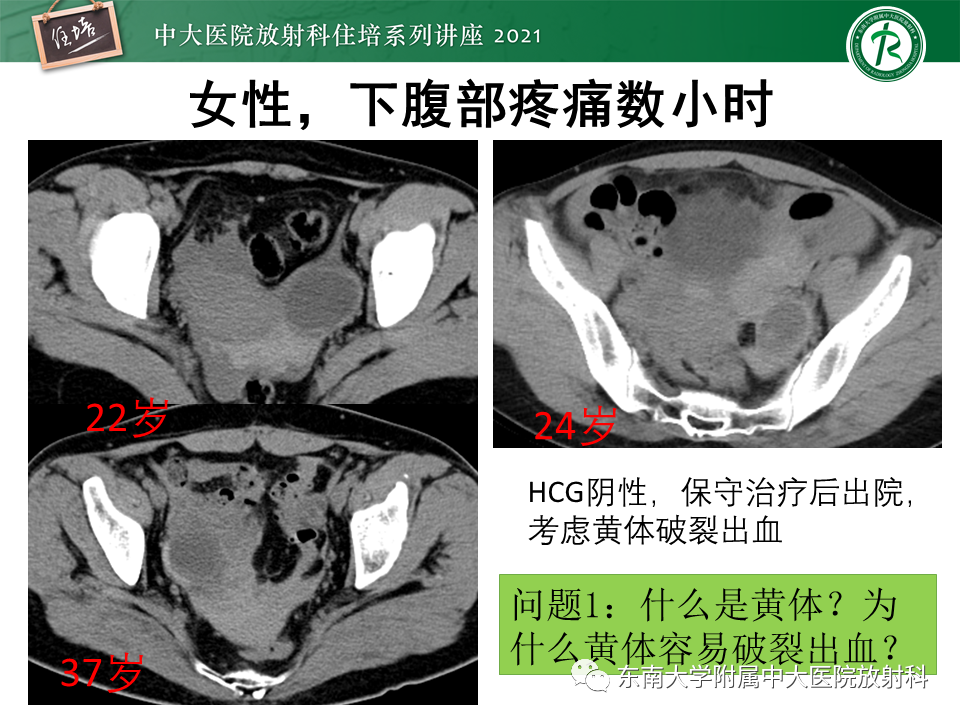 影像PPT - 【PPT】卵巢黄体及相关疾病诊断及鉴别-6