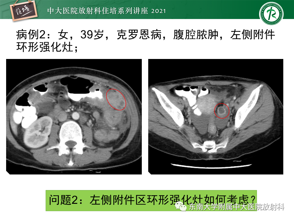 影像PPT - 【PPT】卵巢黄体及相关疾病诊断及鉴别-7