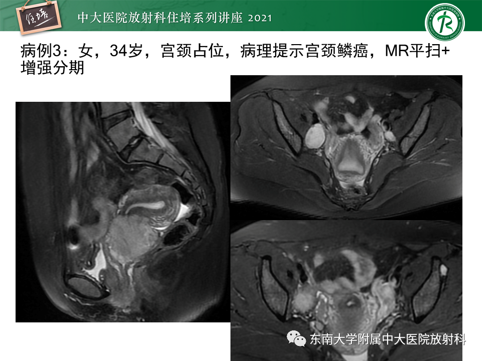 影像PPT - 【PPT】卵巢黄体及相关疾病诊断及鉴别-8
