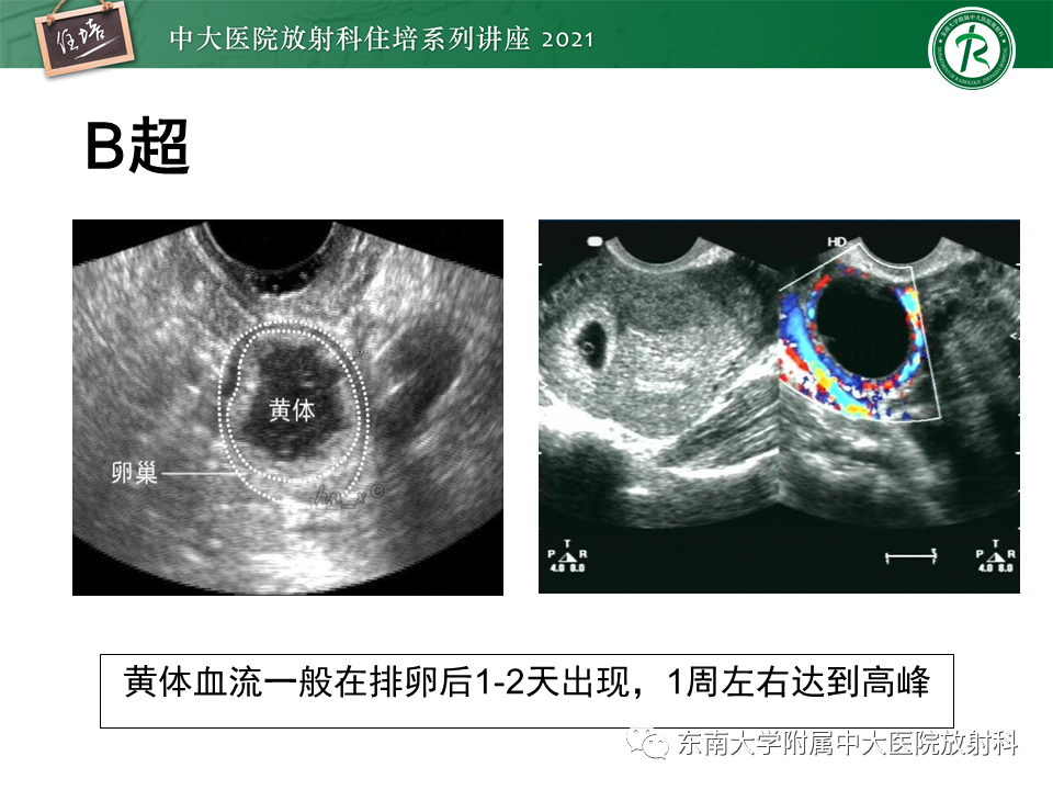 影像PPT - 【PPT】卵巢黄体及相关疾病诊断及鉴别-14