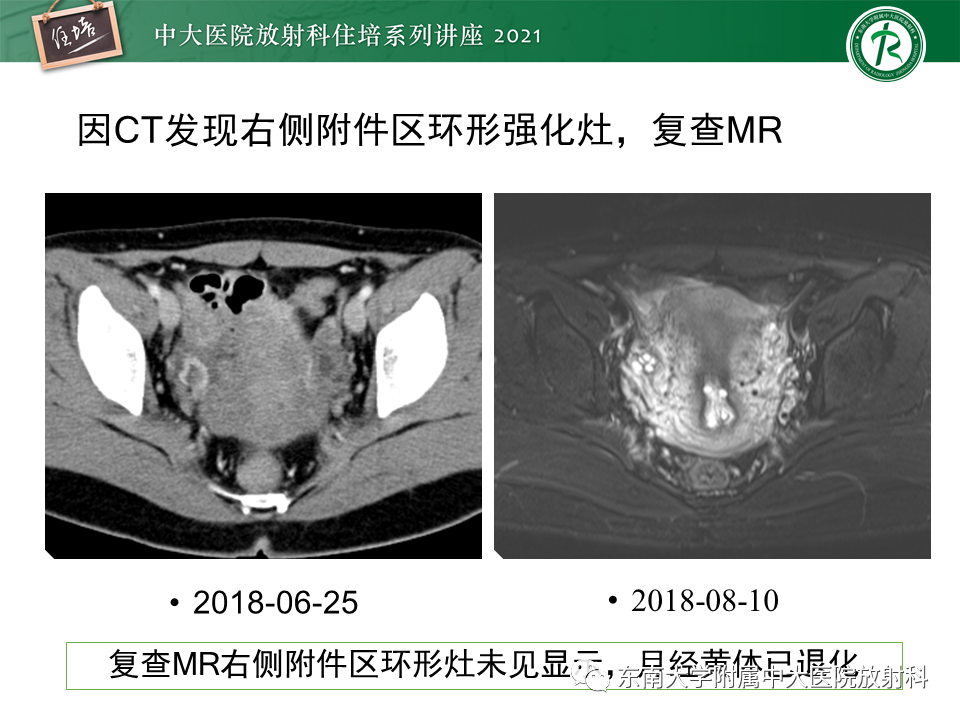 影像PPT - 【PPT】卵巢黄体及相关疾病诊断及鉴别-18
