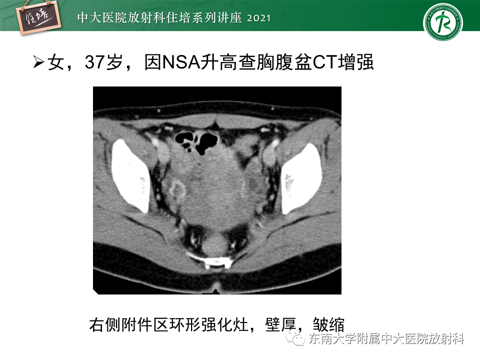 影像PPT - 【PPT】卵巢黄体及相关疾病诊断及鉴别-17