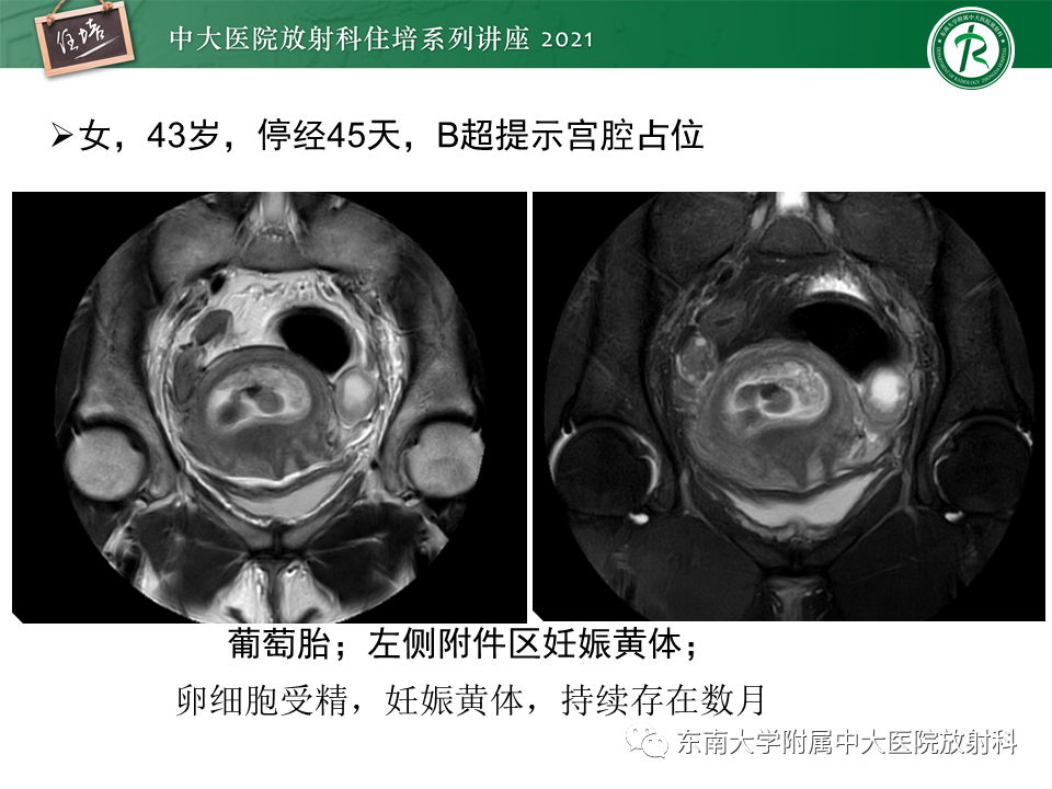 影像PPT - 【PPT】卵巢黄体及相关疾病诊断及鉴别-19
