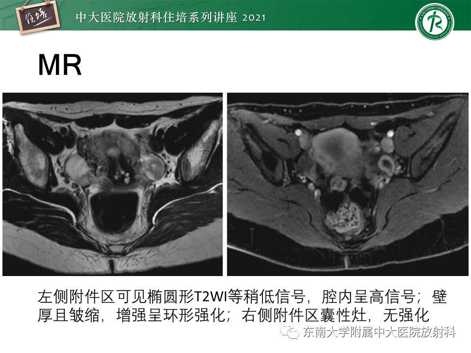 影像PPT - 【PPT】卵巢黄体及相关疾病诊断及鉴别-15