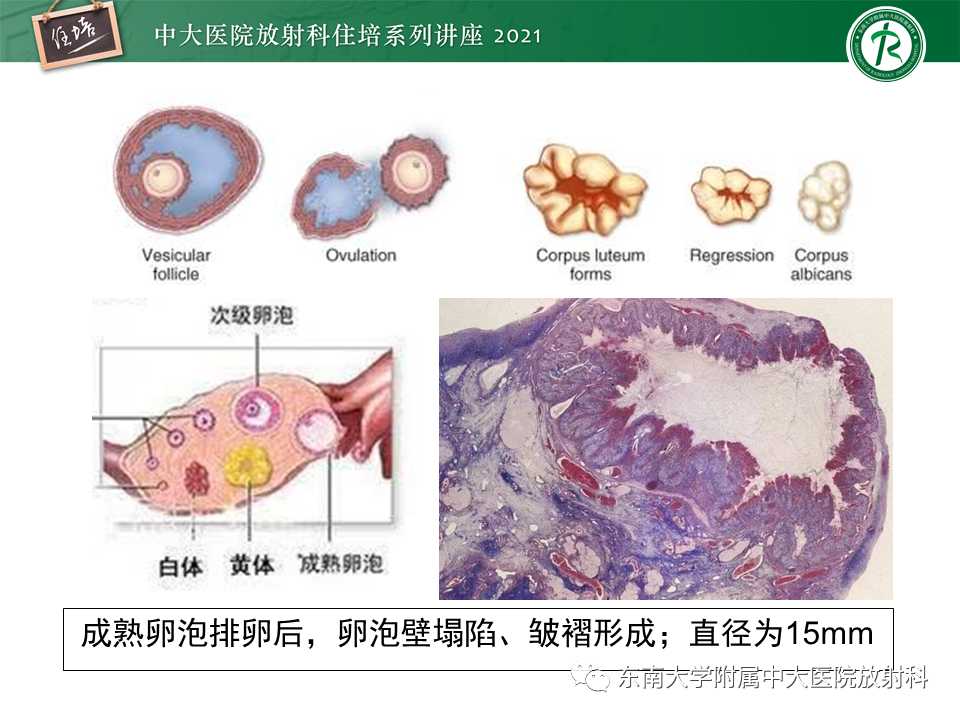 影像PPT - 【PPT】卵巢黄体及相关疾病诊断及鉴别-13