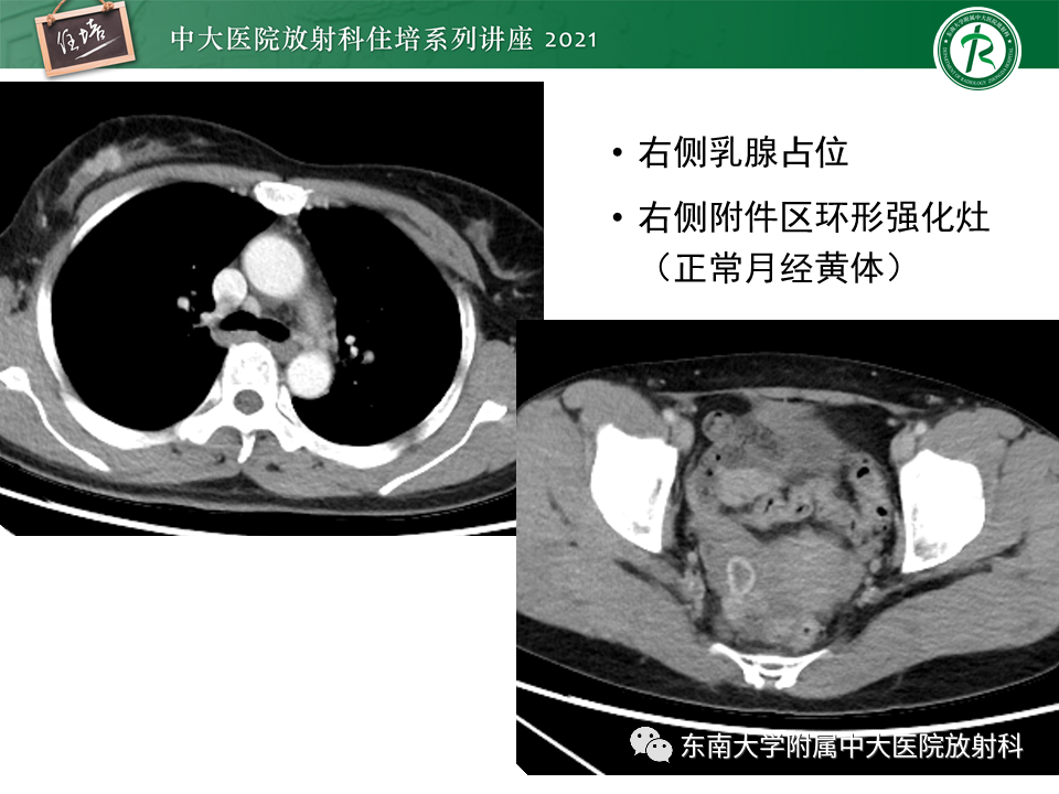 影像PPT - 【PPT】卵巢黄体及相关疾病诊断及鉴别-26