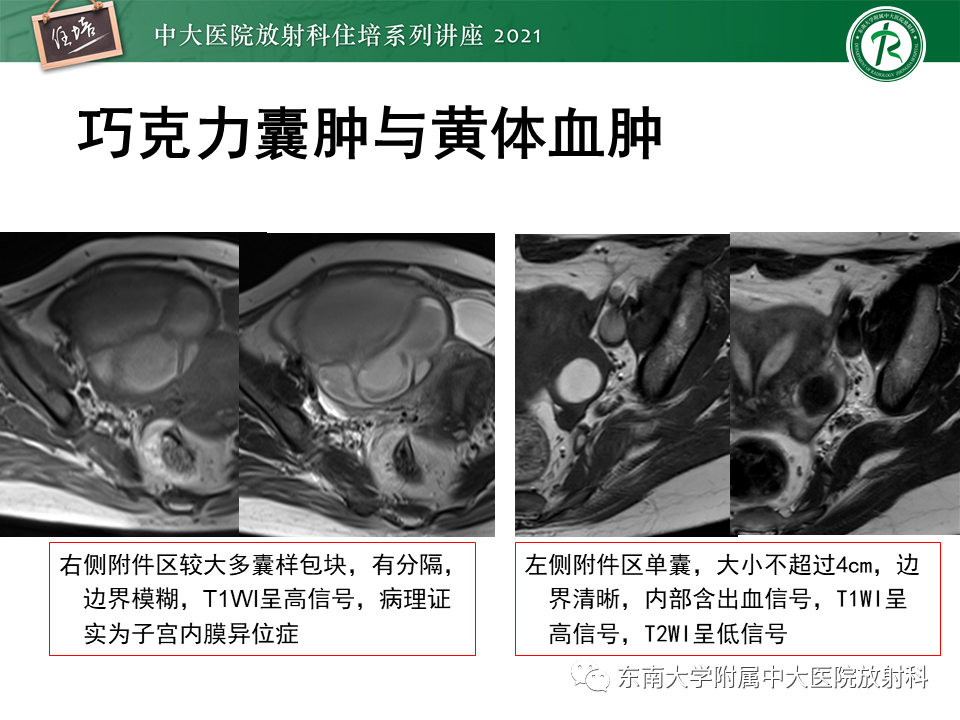影像PPT - 【PPT】卵巢黄体及相关疾病诊断及鉴别-28