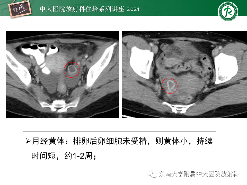 影像PPT - 【PPT】卵巢黄体及相关疾病诊断及鉴别-33