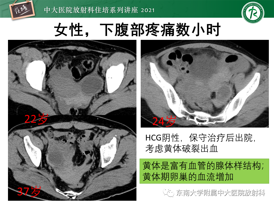 影像PPT - 【PPT】卵巢黄体及相关疾病诊断及鉴别-36