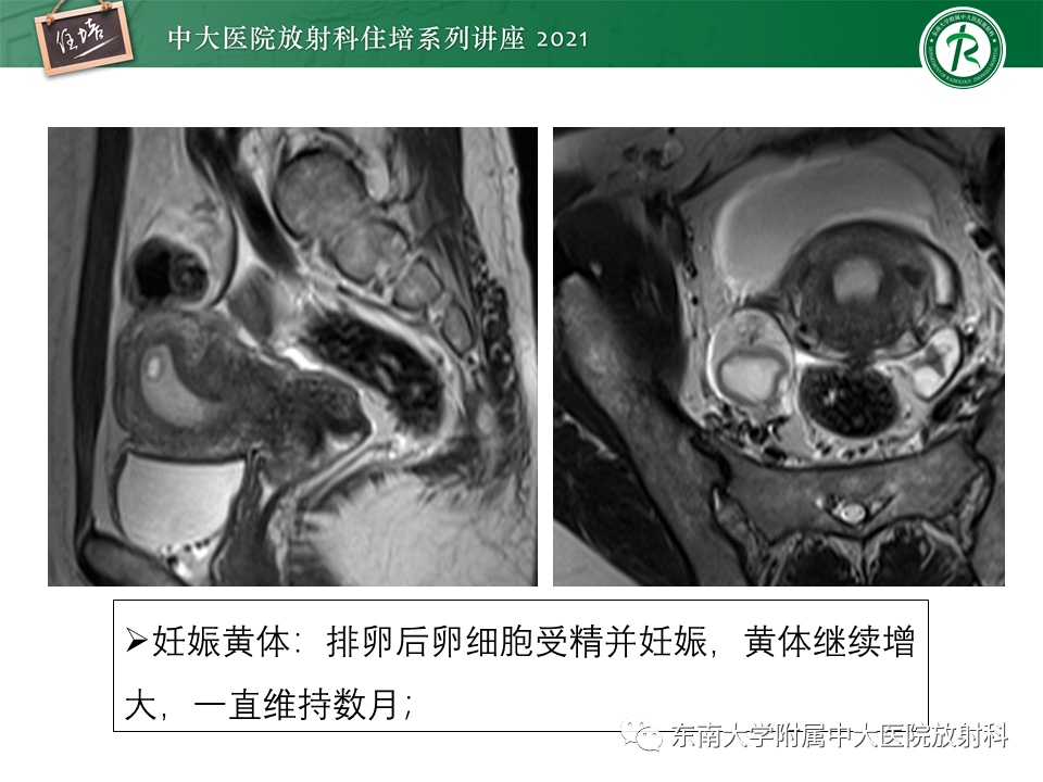 影像PPT - 【PPT】卵巢黄体及相关疾病诊断及鉴别-34
